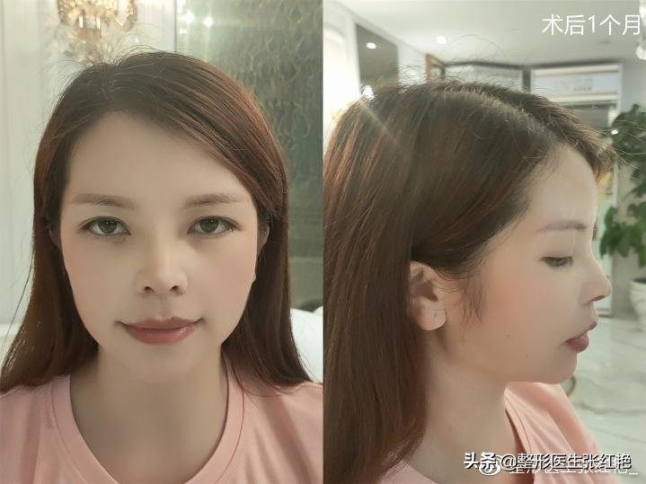 塌鼻头大鼻头怎么修容,塌鼻子和大鼻头如何变高挺