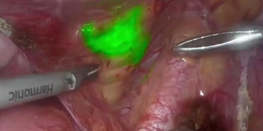 荧光腹腔镜手术配合,荧光腹腔镜手术