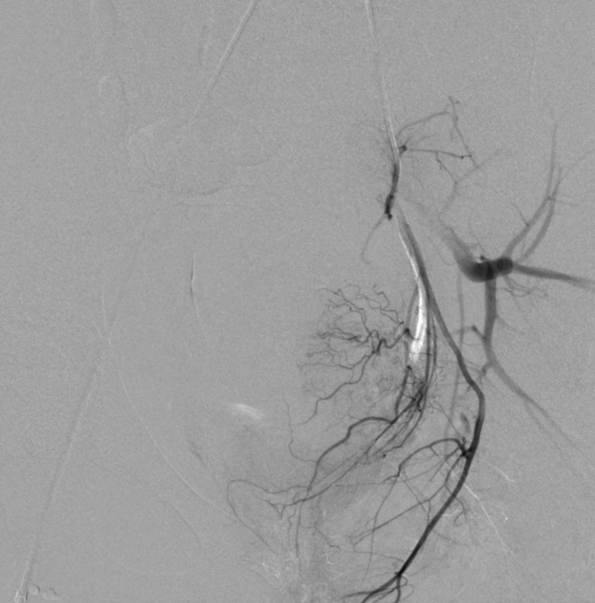 14岁女孩非经期出血,14岁女孩非月经期出血是怎么回事