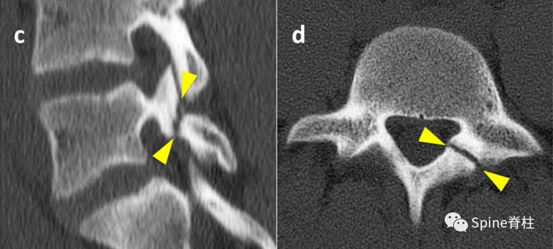 轻度峡部裂和重度峡部裂的区别,真性峡部裂和假性峡部裂