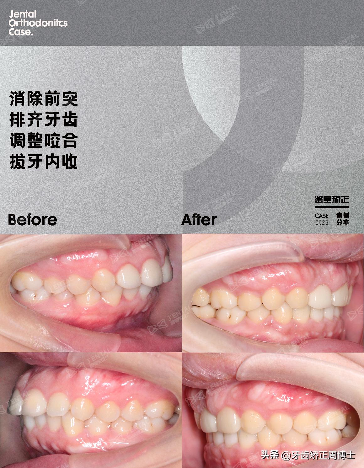 骨性上颌前凸嘴怎么矫正,厚嘴唇与嘴凸有关吗