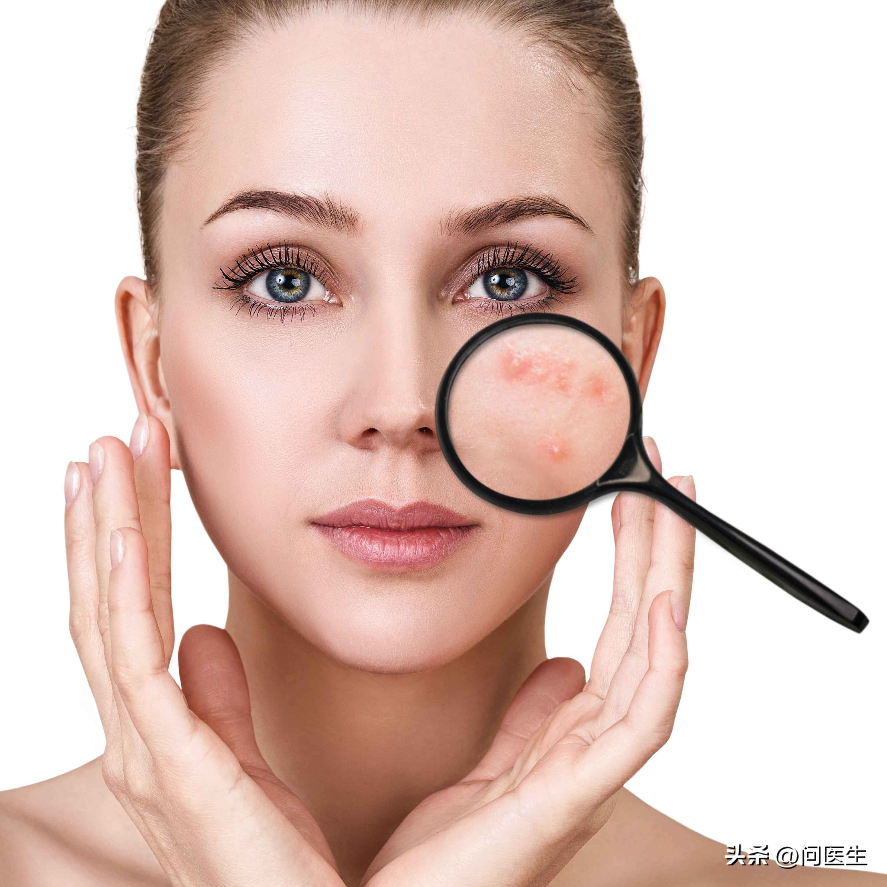 挤痘痘到底用手挤还是用粉刺针,女子挤痘致脸部感染缝了6针