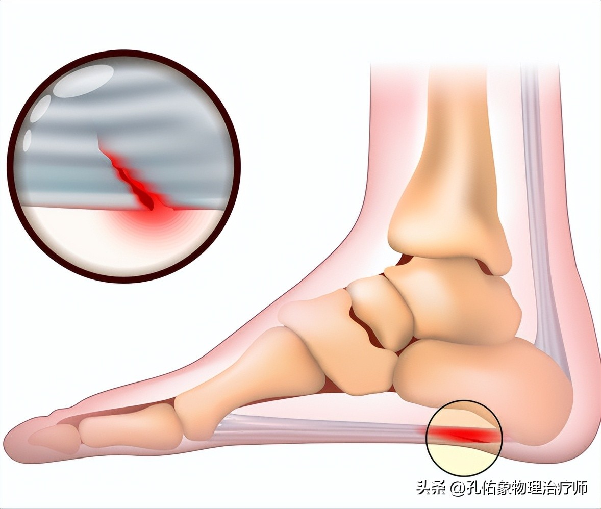 脚部信号透露健康问题,脚部出现这6种症状