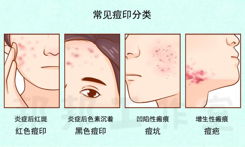 痘印全攻略——不同类型的治疗选择