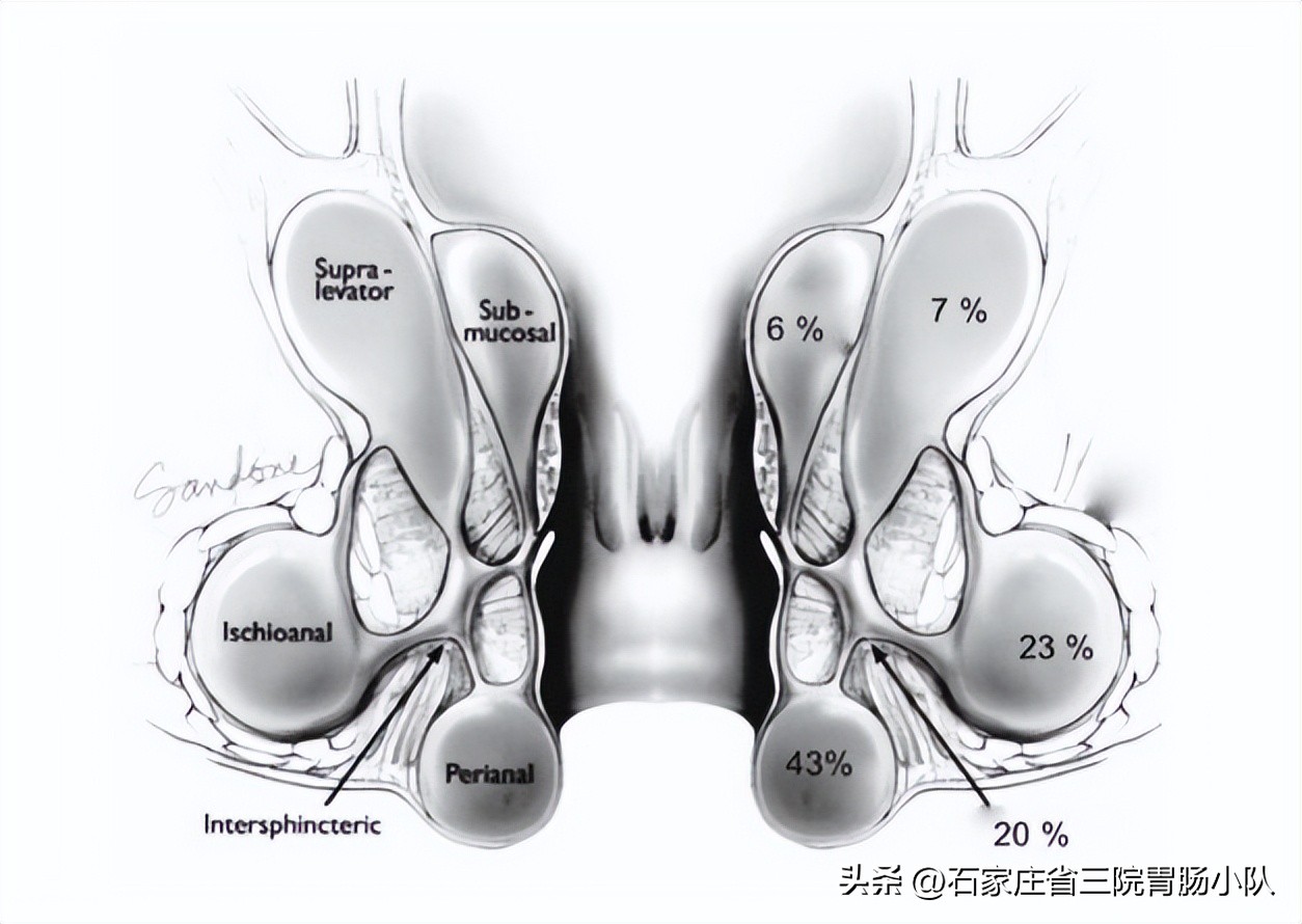 肛周脓肿中医说法怎么引起的,肛周脓肿经历描述