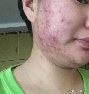 如果长了青春痘应该怎样快速去除,青春痘怎么消除要预防哪些问题