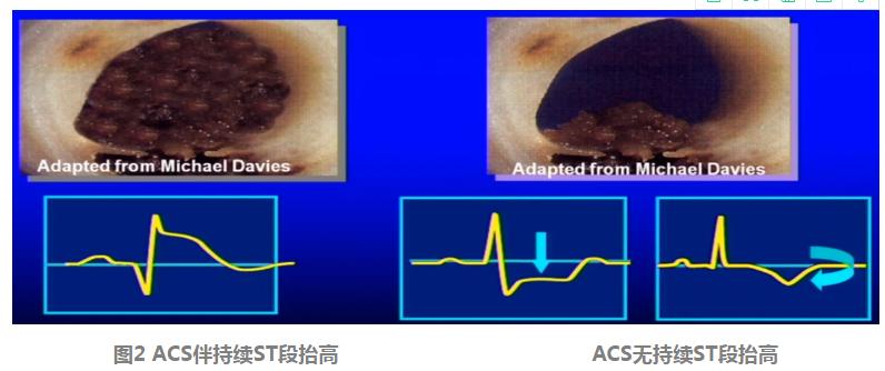 胸痛的应对知识技能培训,胸痛基础知识讲解视频