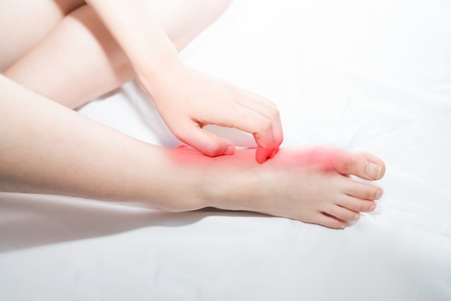 真菌感染的脚气是什么原因造成的,真菌性脚气传染又痒又肿用什么药