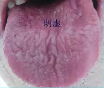 舌根部有裂纹是什么舌象,舌有裂纹7种原因通过舌象来调理