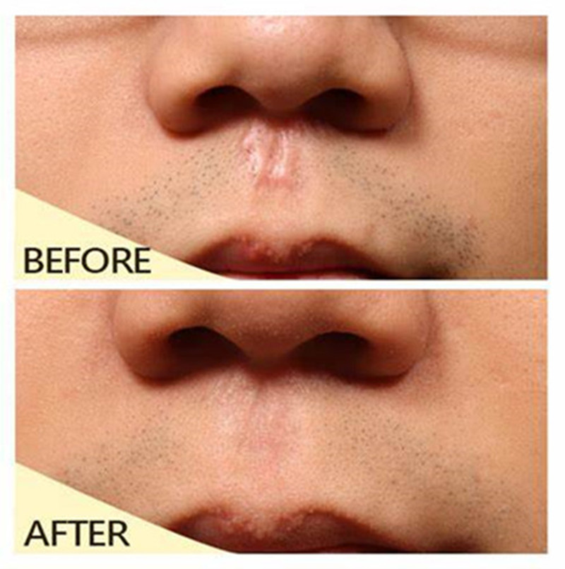 3个月的疤痕增生还能消除吗,莫名其妙长了个增生疤痕