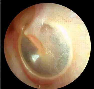 分泌性中耳炎引起的传导性耳聋,儿童急性分泌性中耳炎会致耳聋吗