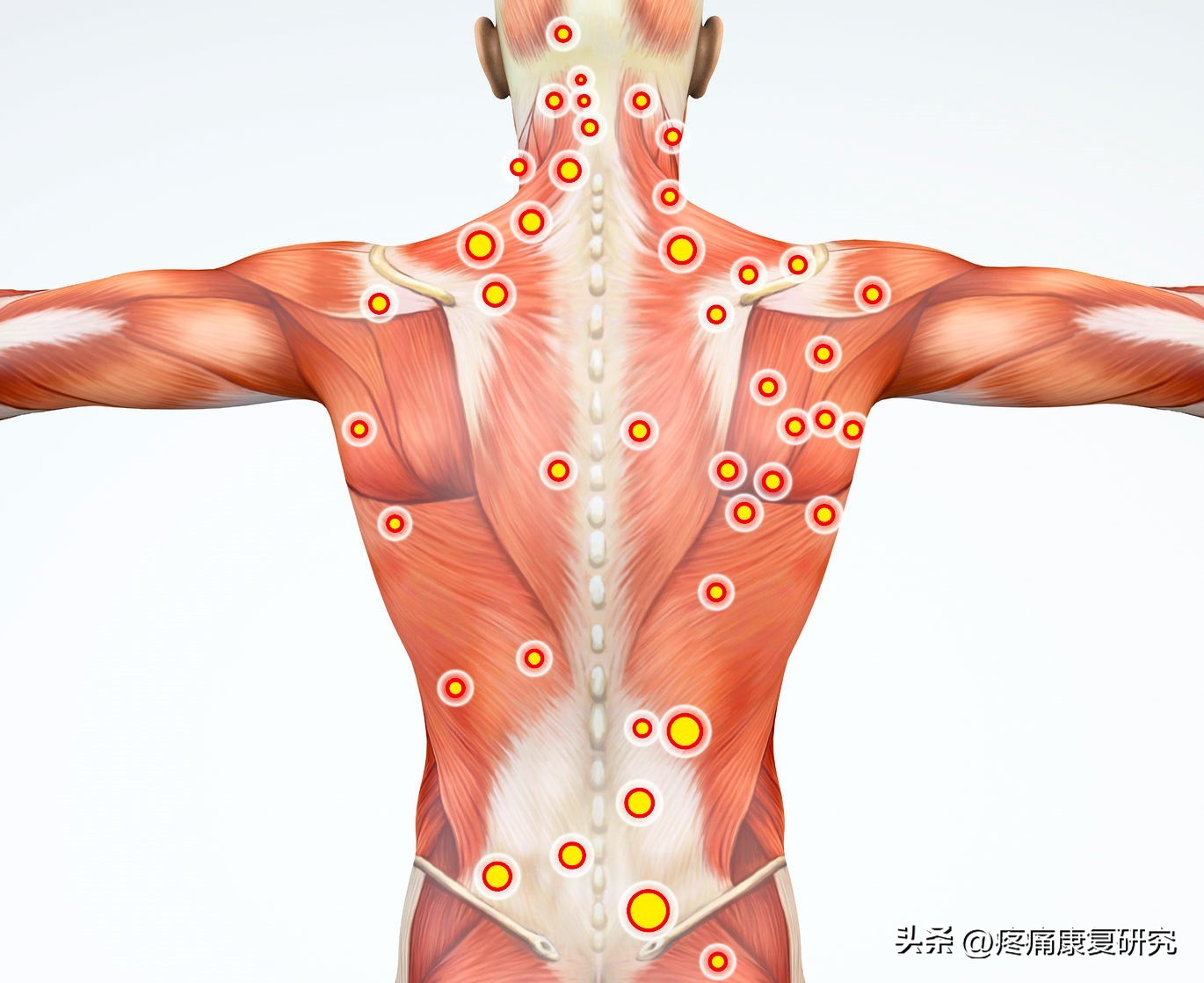 针灸止痛的原理图,针灸镇痛已被国际公认