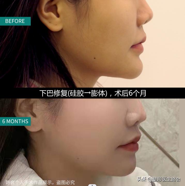 做假体下巴后的真实感受,做了假体下巴很后悔