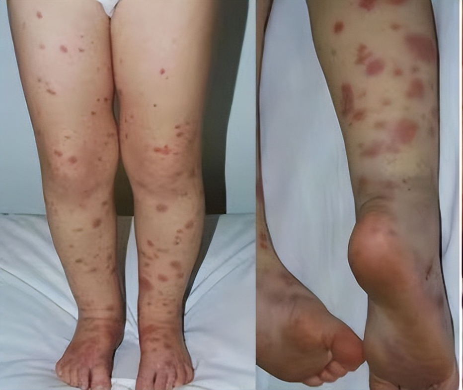 儿童得了iga肾炎怎么办,儿童iga能治疗好吗