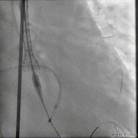 病例回顾与分享,腹膜后血肿介入治疗