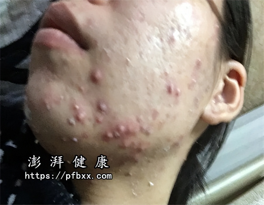 脸上长出硬硬的小鼓包挤出血,脸上长硬硬的小鼓包流脓血