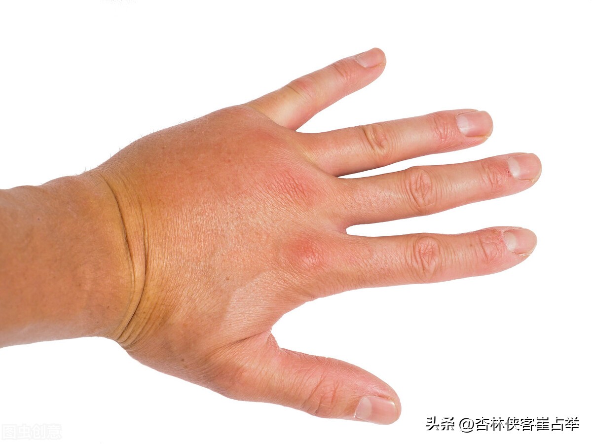 冬病夏治，抓住三伏尾，解读一个中成药，逼出关节里的风、寒、湿