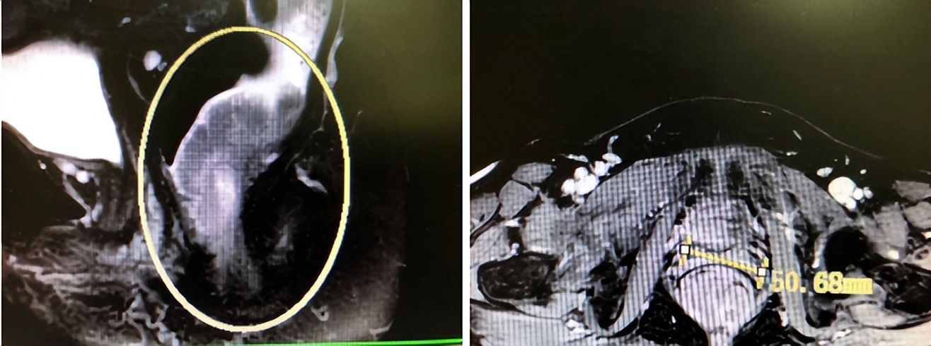 5厘米超低位保肛手术难度,挑战极限保障型