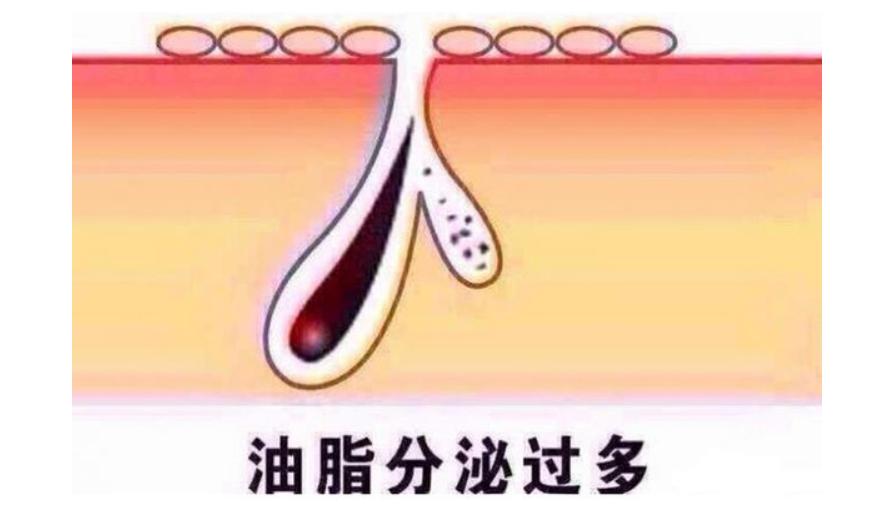 脸上痘痘里面有白米粒是什么原因,脸上频繁长脓包痘痘是什么原因