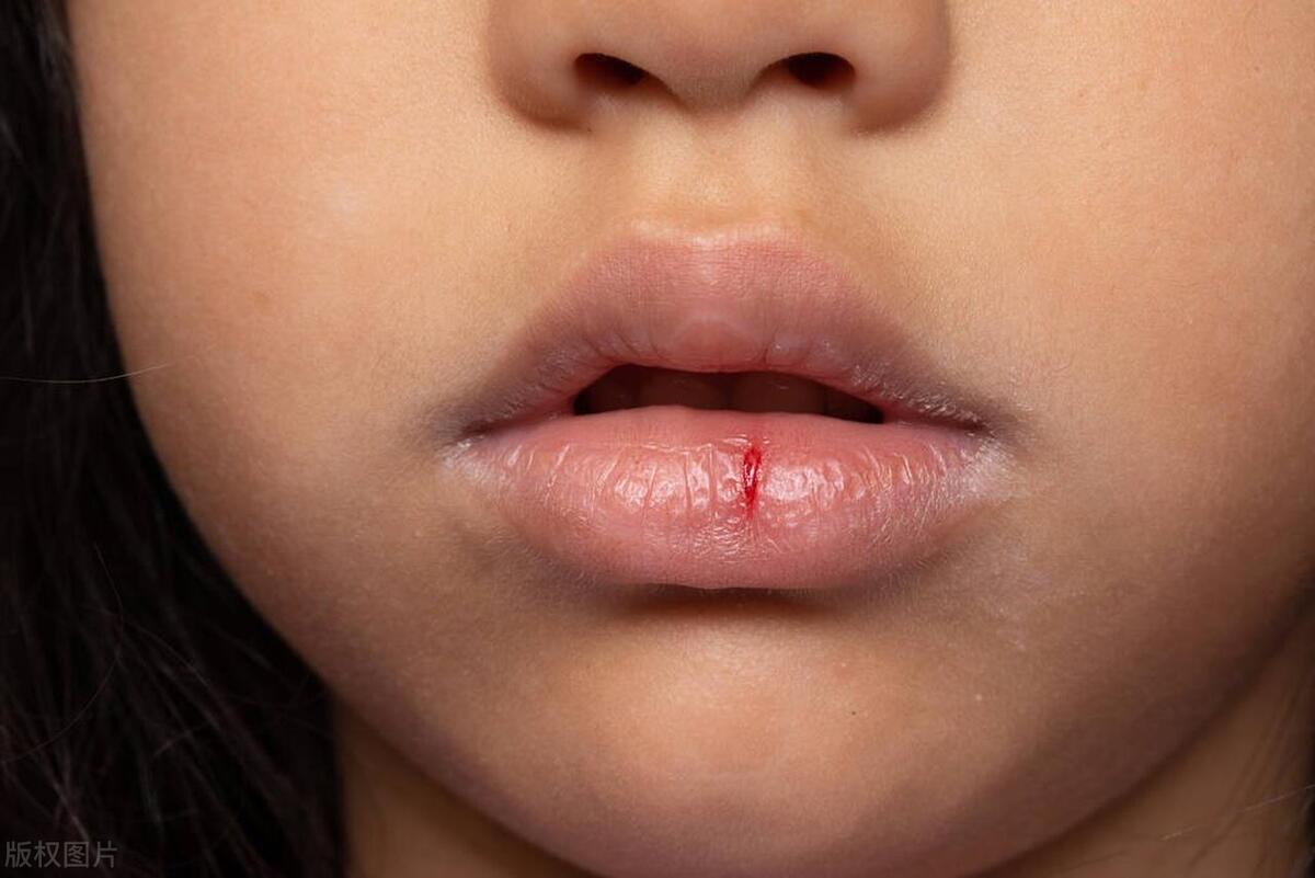 痰多怎么就治不好了,除顽痰中成药有哪几种