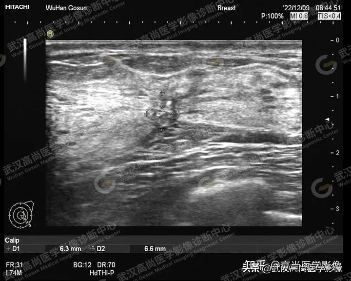 乳腺超声病例,乳腺肿块巨大超声结果4a