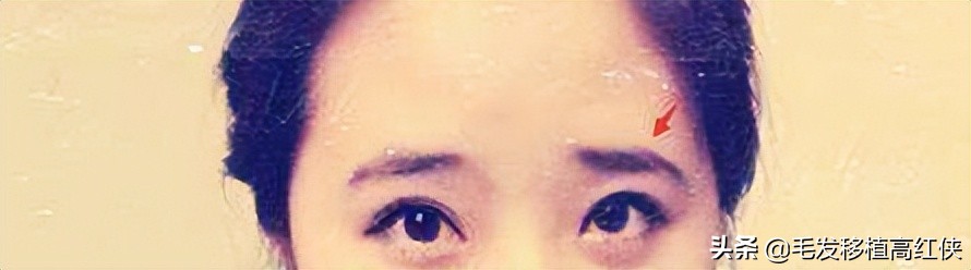 男人眉毛稀疏就要植眉,眉毛稀疏怎么植眉