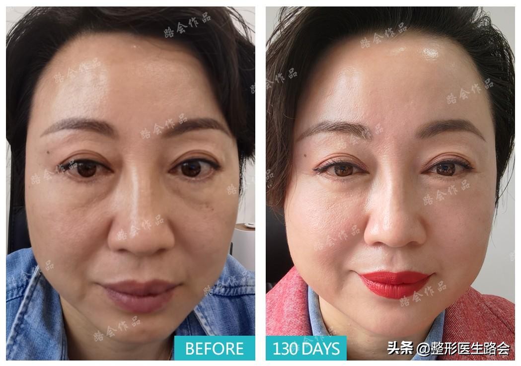 眼袋类型分不清,眼袋卧蚕傻傻分不清