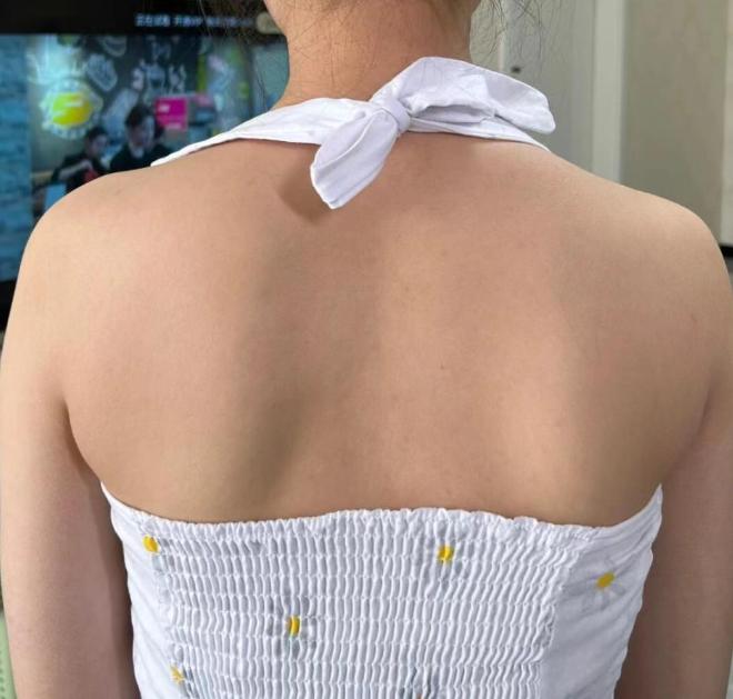 冒脓痘痘,痘痘痘印脓包怎么去除