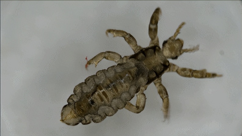 七岁孩子头发上怎么长虱子,小孩头发长头屑虱子