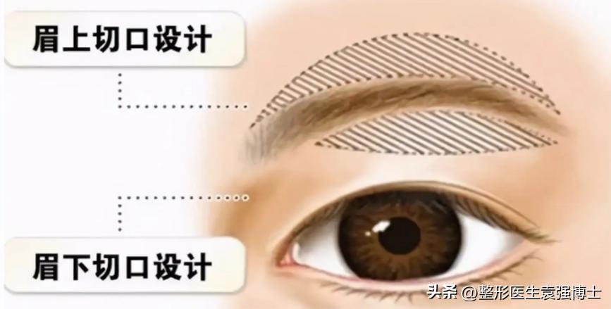 上眼皮耷拉、三角眼、眼皮松，医生说这两种方法很实用