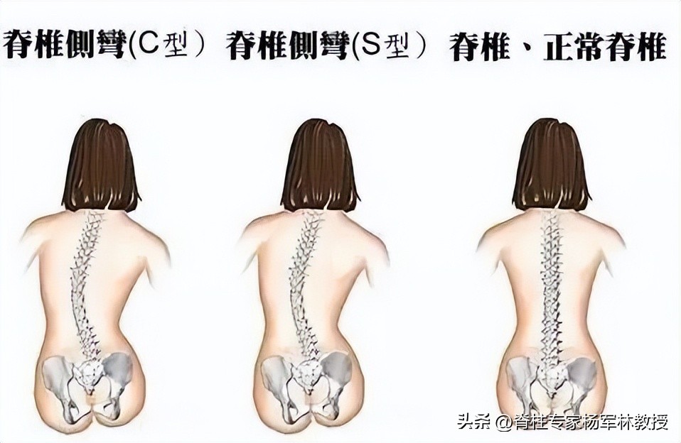 脊柱侧弯10度会出现剃刀背吗,剃刀背会误诊吗