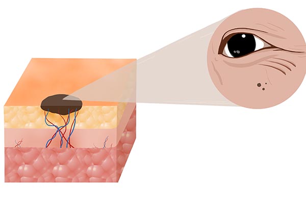 长在身体哪些部位的痣要特别注意,身上长的痣哪一种痣最危险