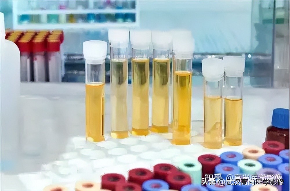 尿检报告怎么看?为什么尿检要“中段尿”?