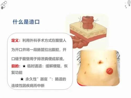 结肠癌患者术后吃什么最好,结肠癌术后的饮食注意事项