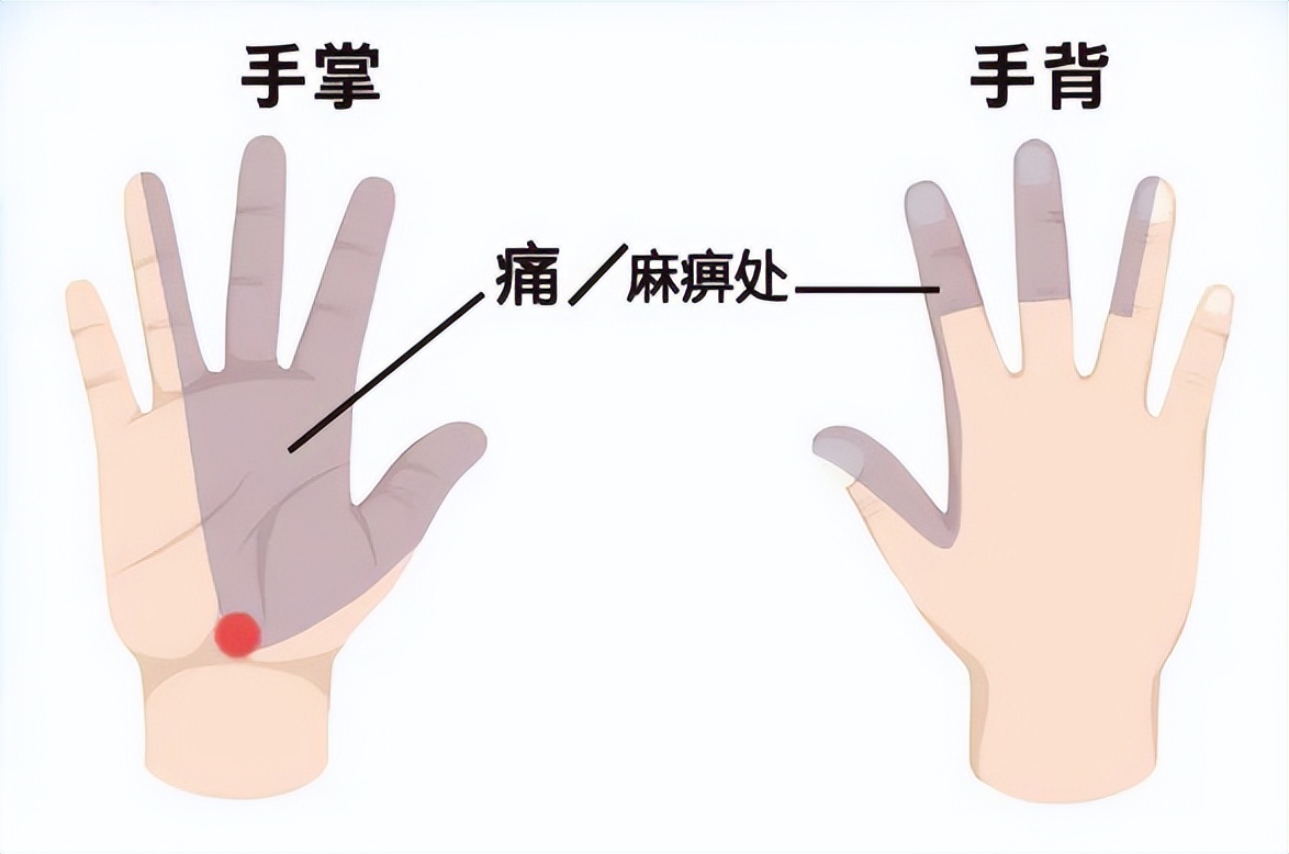 手麻握不住东西怎么锻炼,手麻无力最快的恢复手法