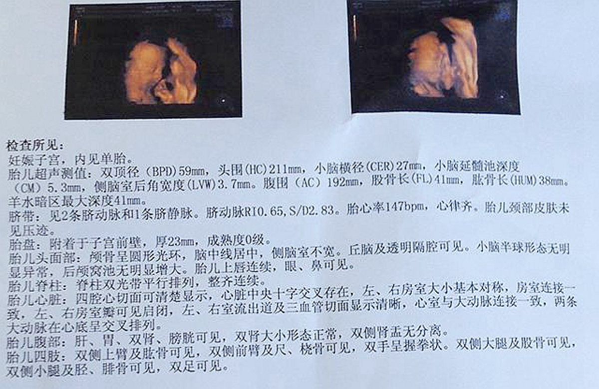唐氏儿和正常胎儿的区别,唐氏儿和正常孩子的区别