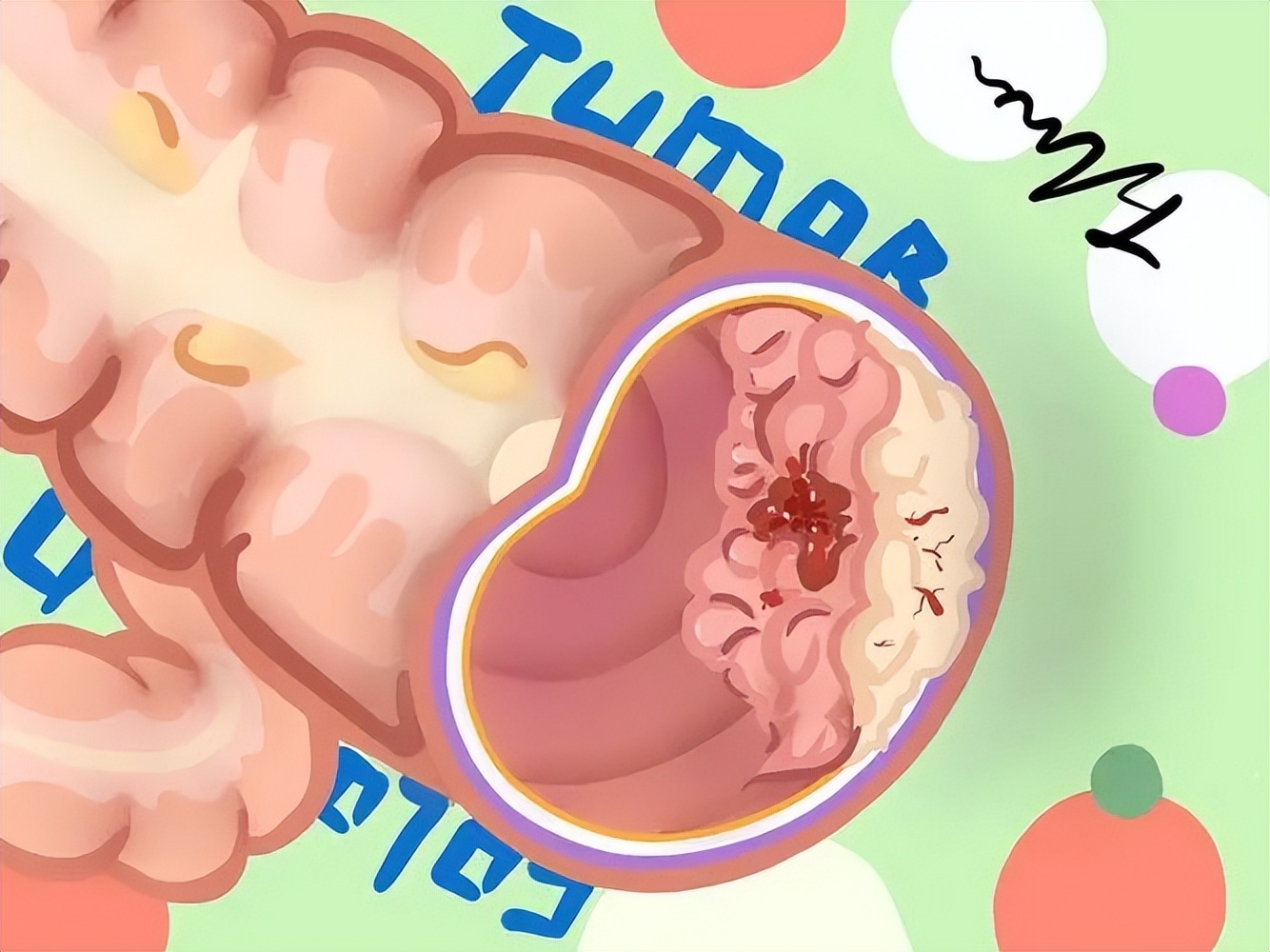 结肠癌用达芬奇机器人手术行吗,结肠癌达芬奇机器人手术时间多久