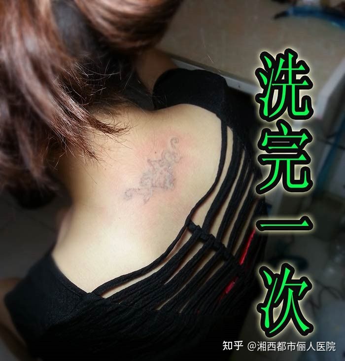 吉首市洗纹身哪家好,张家界洗纹身的价格