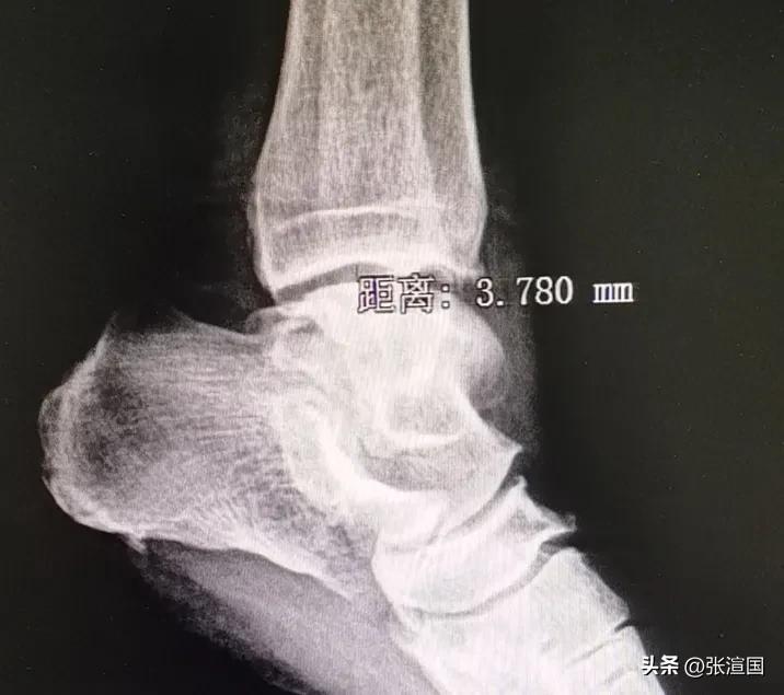 崴脚诊断术语,崴脚的诊断证明