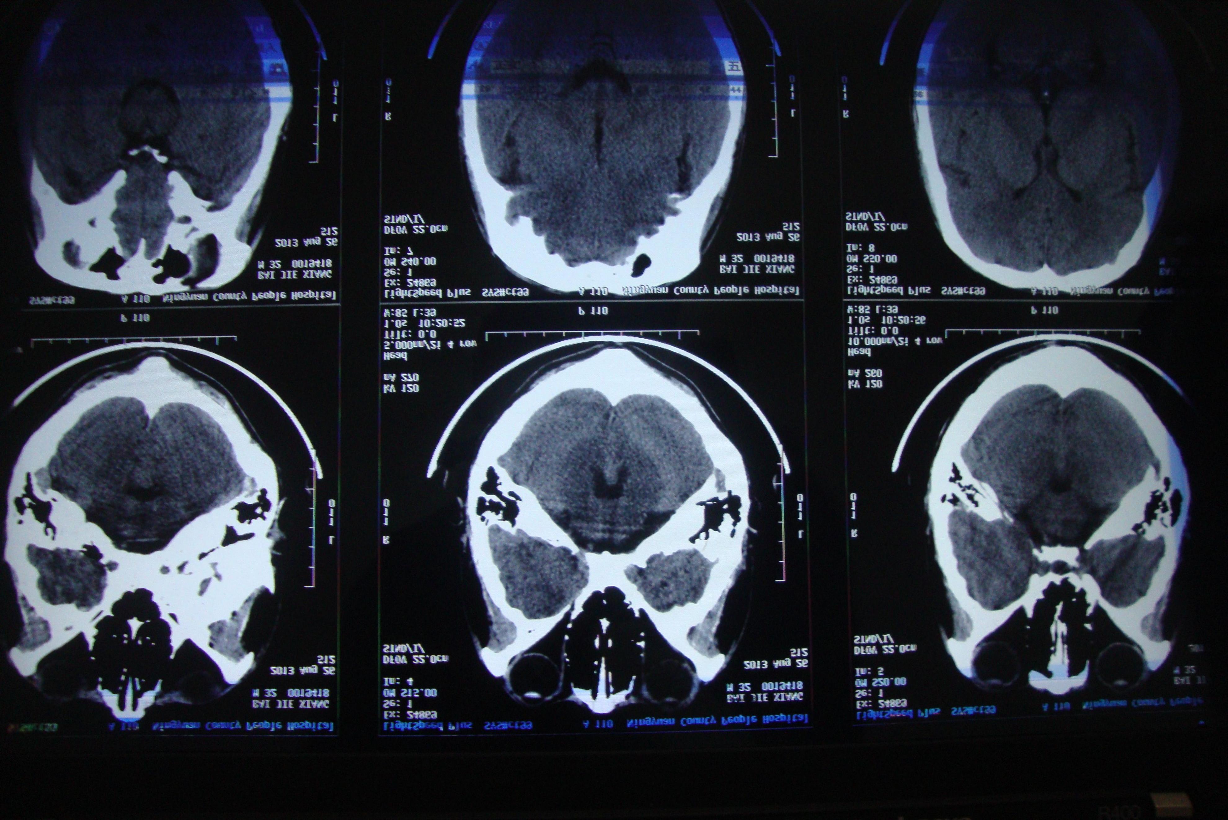 年龄大了得了脑萎缩该如何解决,50多岁轻微脑萎缩要注意什么