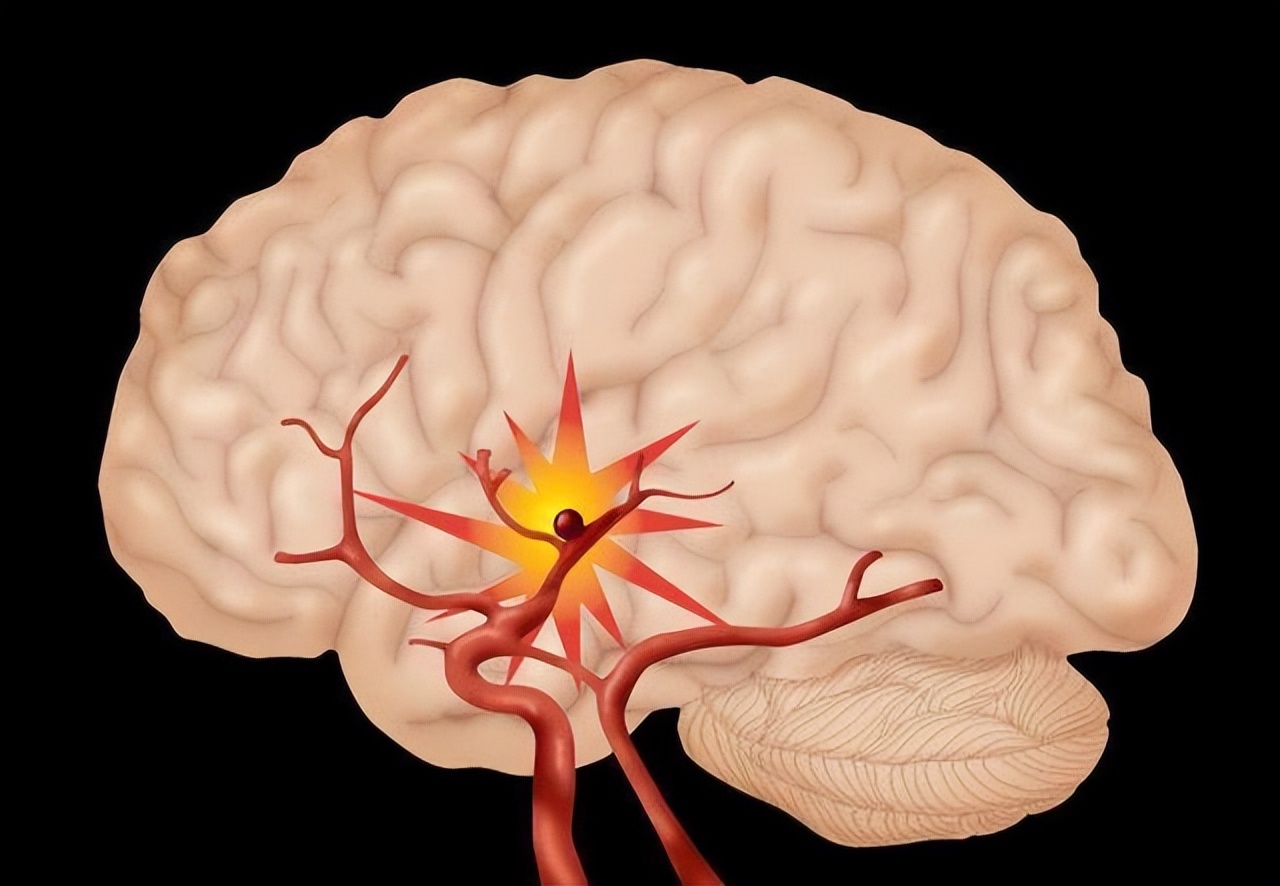 脑出血来临前身体有8种征兆,脑出血来临睡觉先知
