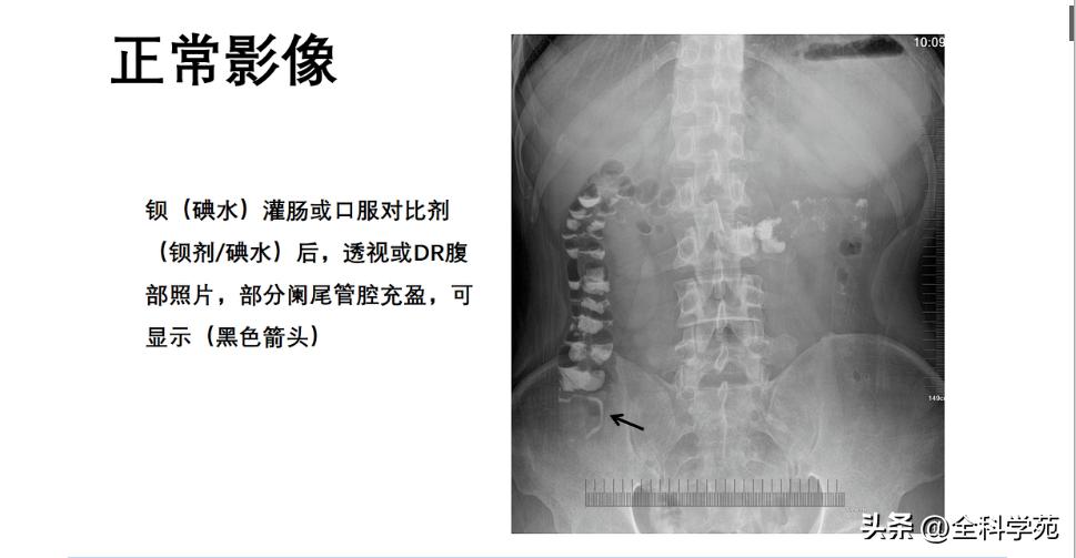 阑尾炎的讲解,关于阑尾炎的讨论总结