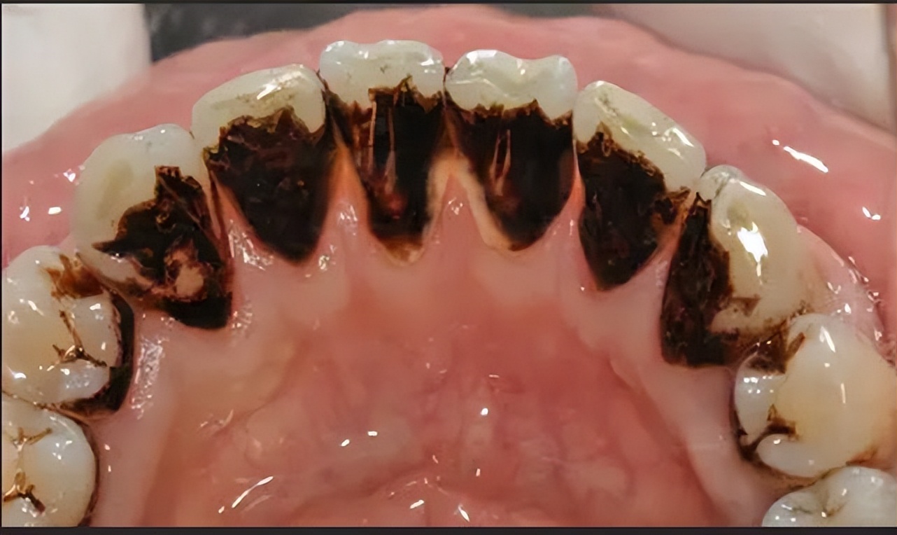 满嘴黑黝黝的牙渍、烟渍去不掉?掌握这几招,牙齿立刻亮白如新!