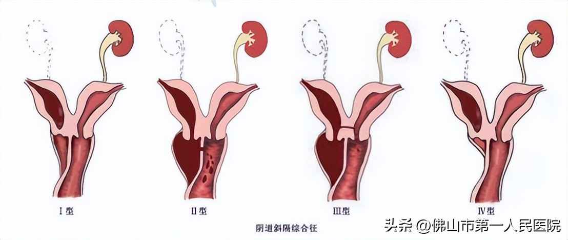 不损伤处女膜，未婚者治疗阴道斜隔综合征有办法