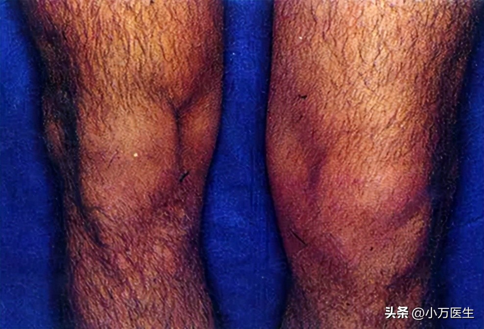 半月板后角撕裂微创手术,半月板撕裂分型