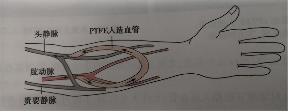 人工血管透析的效果,人工血管血液透析