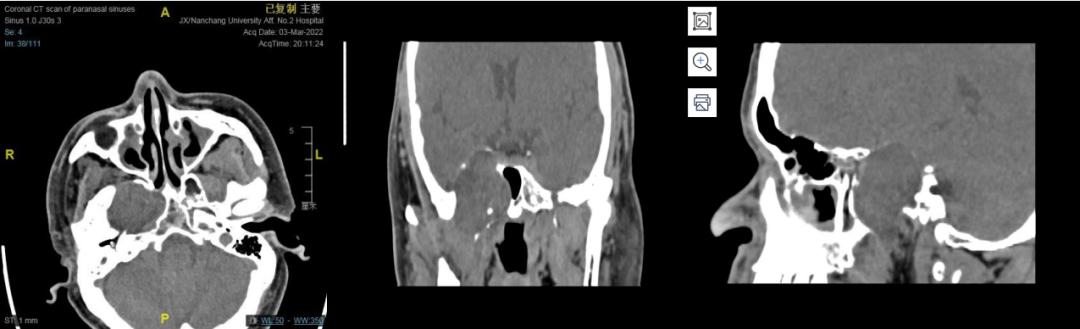 南昌二附院耳鼻喉科手术,南昌大学第二附属医院耳鼻咽喉科