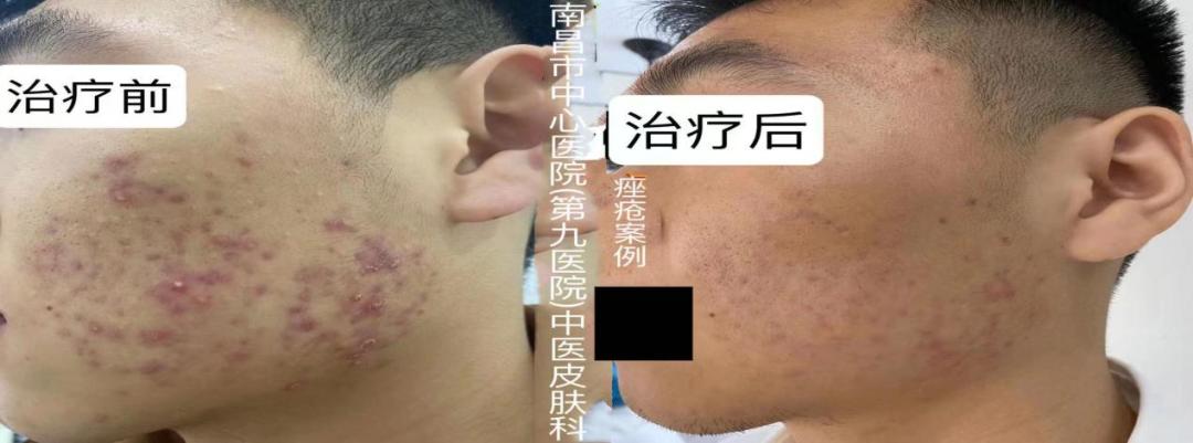 想拥有光滑无痘的脸，别再做这个动作了