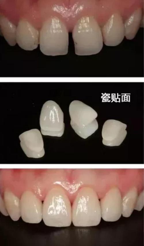 娱乐圈明星烤瓷牙,明星烤瓷牙合集