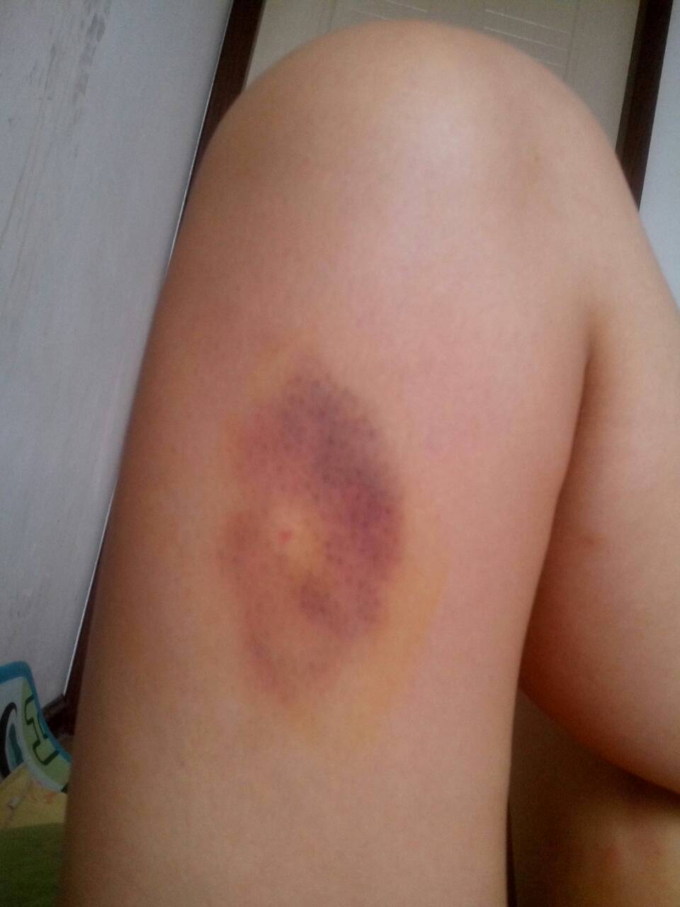 嘴里吃东西咬出黑血泡是咋回事,嘴里吃东西经常起血包怎么回事